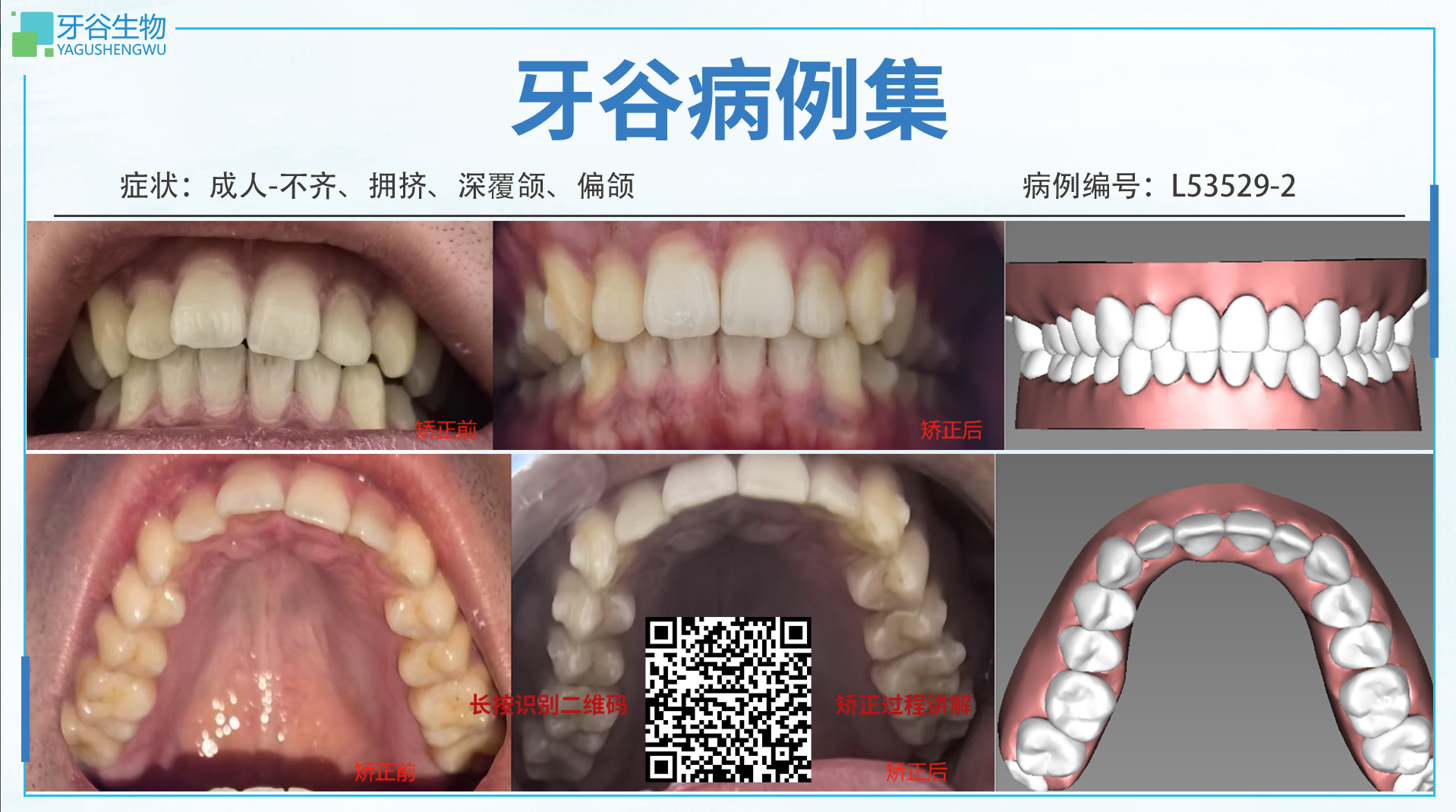 L53529-2，不齐，拥挤，深覆颌 2024/3/12-2024/11/14 