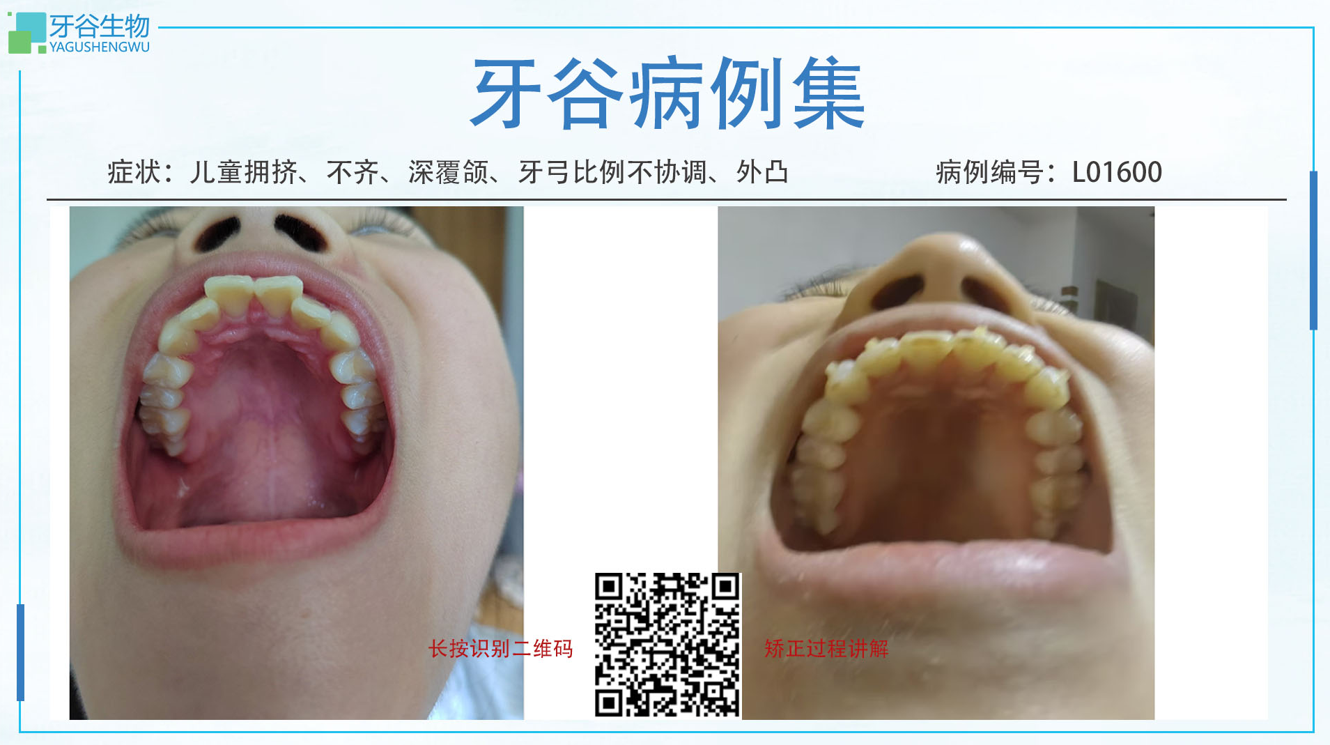 L01600-不齐，拥挤，深覆颌，牙弓比例不协调，外凸	2024/8/18-2025/3/12