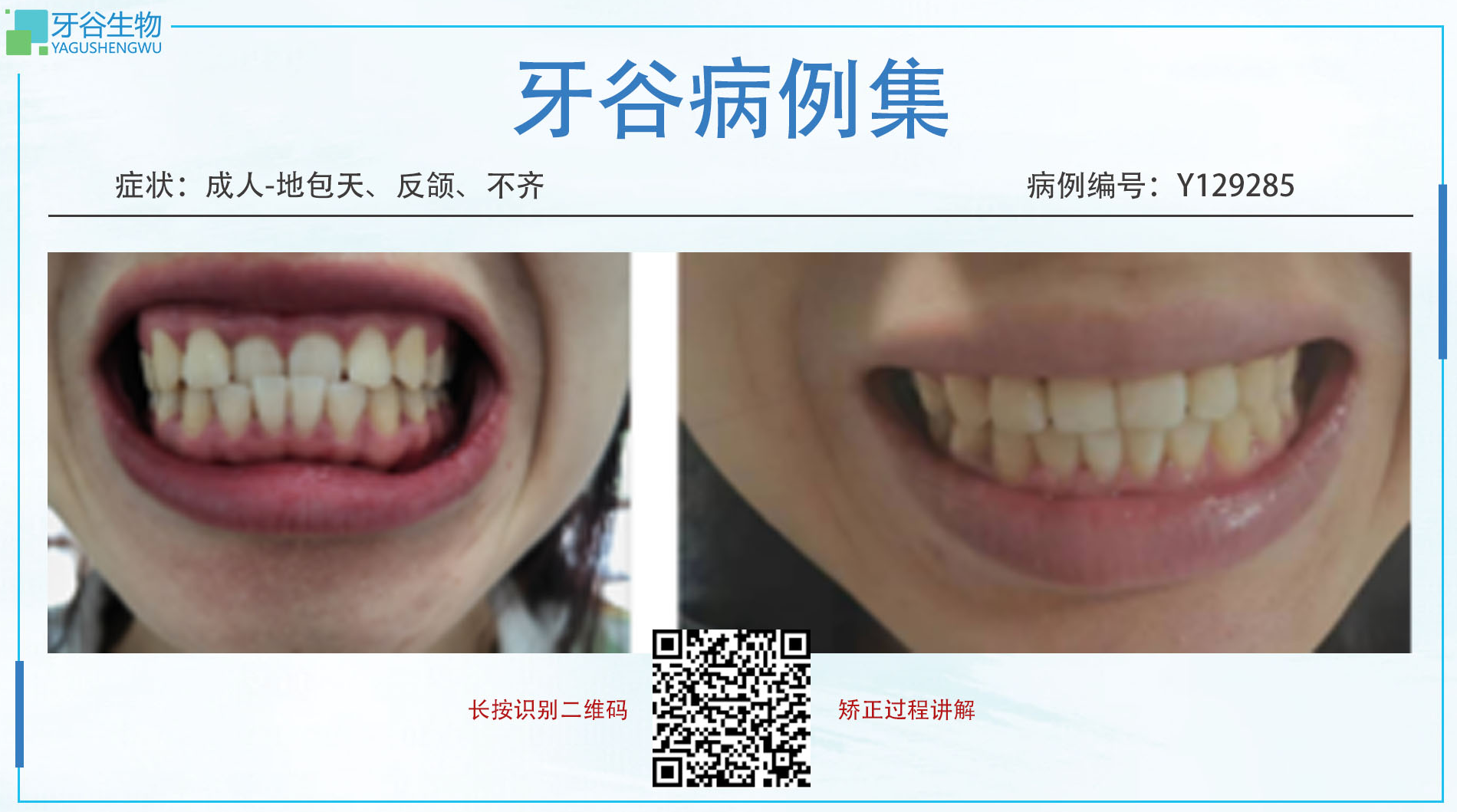 Y129285,地包天,不齐,反颌	2024/8/7 -2025/2/19 